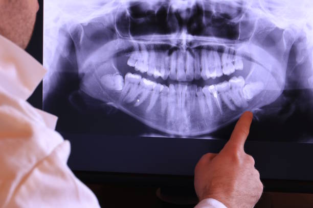 Best Emergency Wisdom Tooth Extraction in Locust Fork, AL